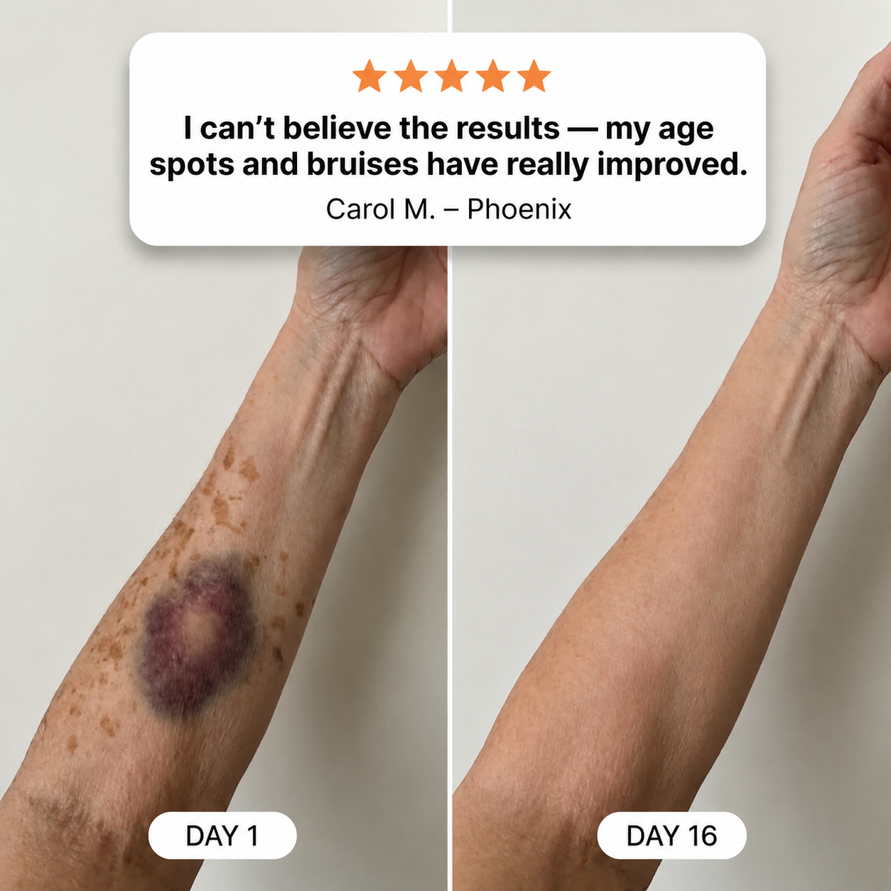 100K+ SOLD 🔥  Dobshow® Dark Spot & Bruise Repair Cream ✨
