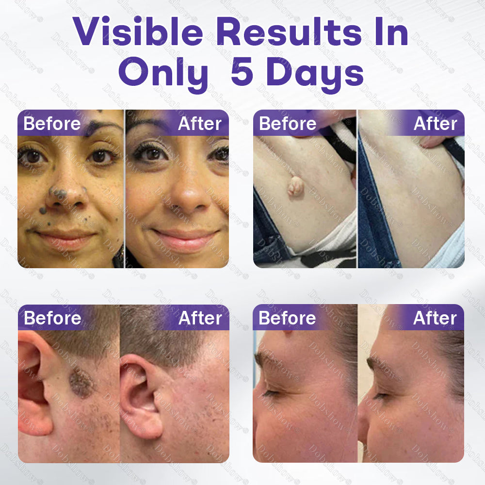 Dobshow®✨ All-New Upgraded Microneedle Wart Removal Patch — Invisible, Discreet Wart Care