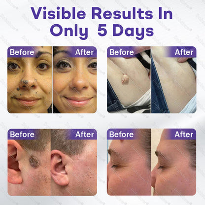 Dobshow®✨ All-New Upgraded Microneedle Wart Removal Patch — Invisible, Discreet Wart Care