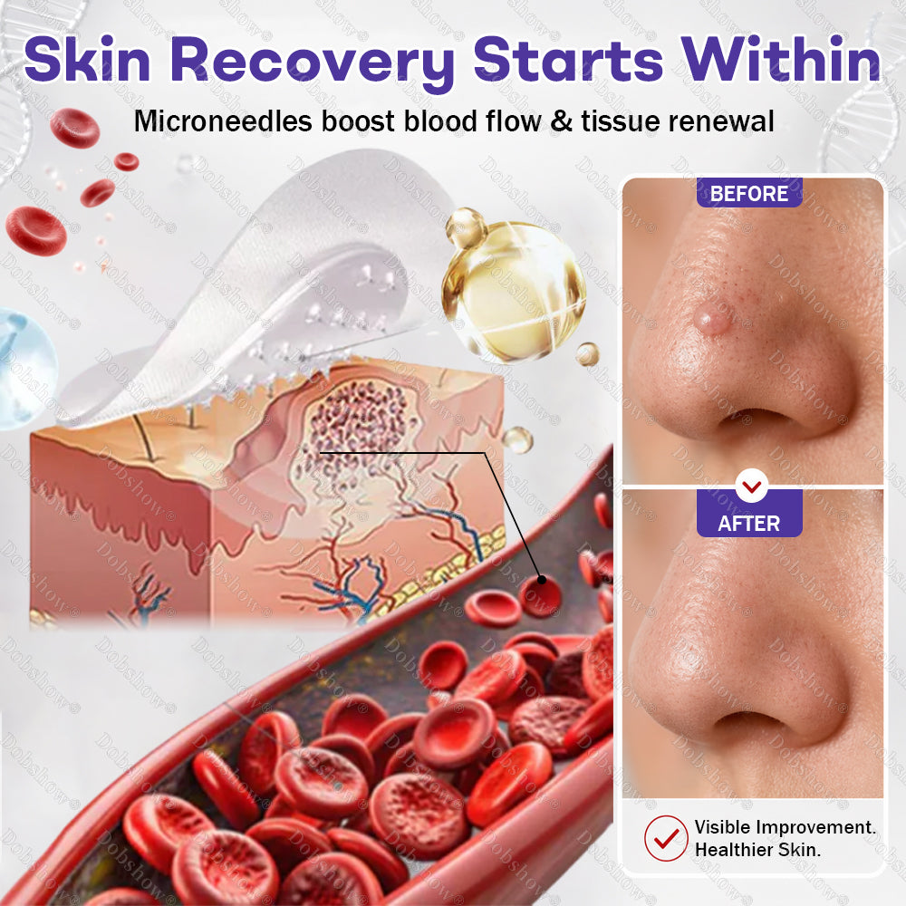Dobshow®✨ All-New Upgraded Microneedle Wart Removal Patch — Invisible, Discreet Wart Care