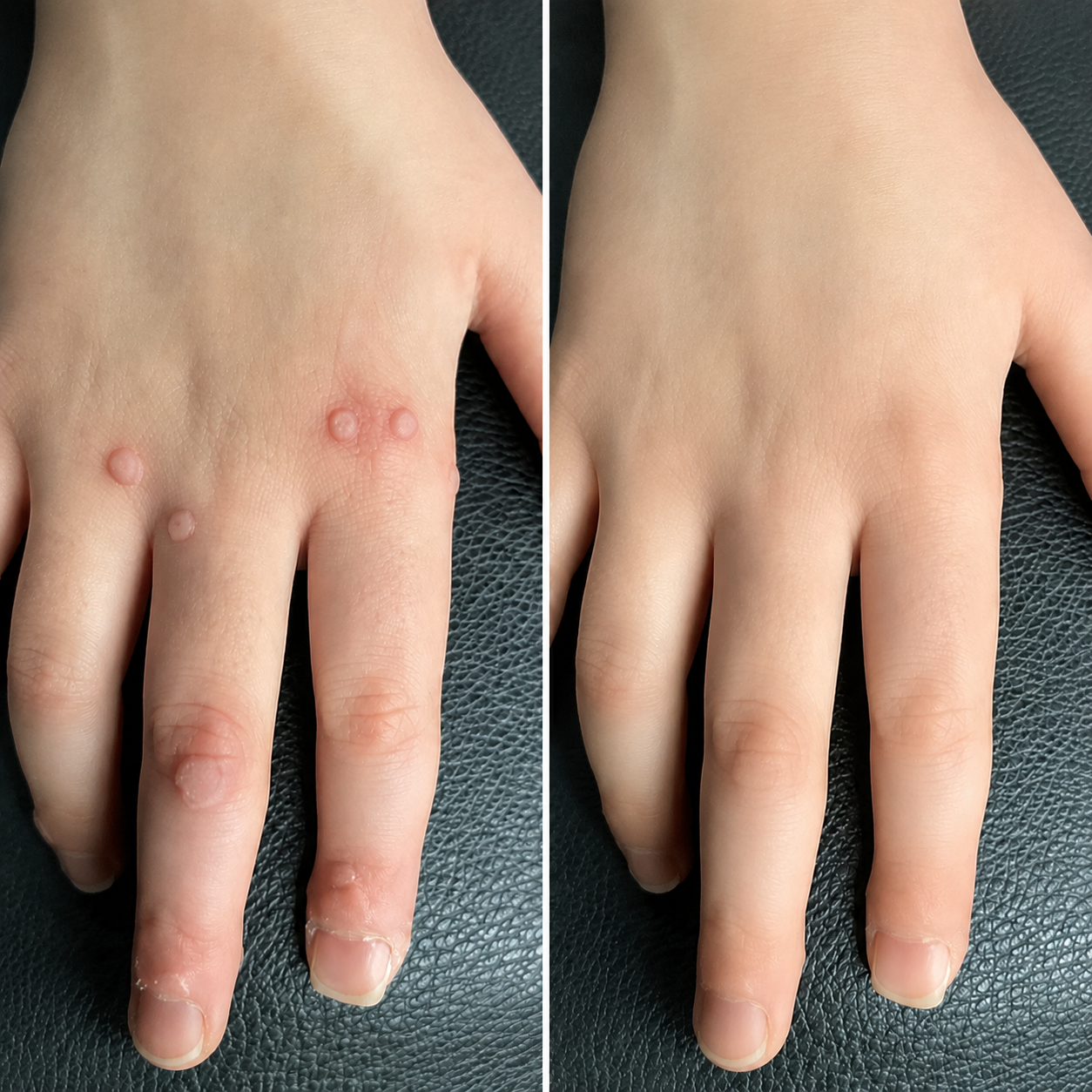 🔥 78K+ Sold! Dobshow® ✨ 2-in-1 Cryo-Cooling Bump Renewal Spray ☘️ Targets Skin Tags, Common Warts & Rough Bumps | Helps Improve the Look of Uneven, Rough Skin | Fast-Drying Formula for Face & Body