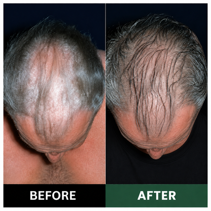 🔥Official U.S. Store  100K+ SOLD 🔥 Dobshow® Avocado & Orange Nourishing Anti-Dandruff Scalp Scrub — A New Steroid-Free Way to Heal an Itchy, Flaky Scalp!✨✨